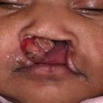 Cleft Lip Before & After Patient #1101