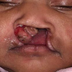 Cleft Lip Before & After Patient #1101