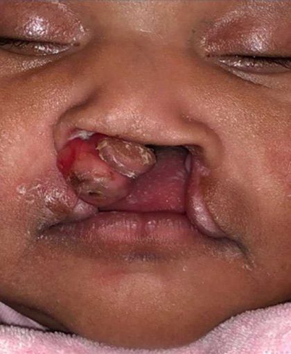 Cleft Lip Before & After Patient #1101