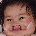 Cleft Lip Before & After Patient #1104