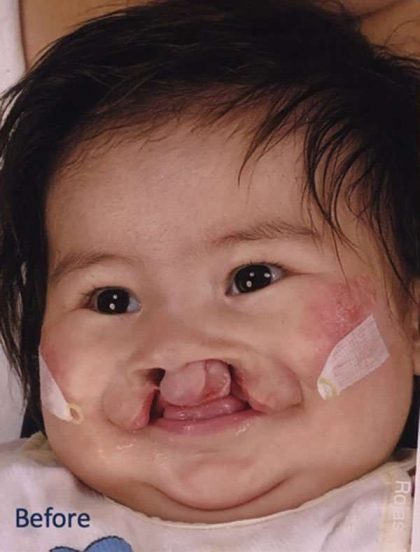 Cleft Lip Before & After Patient #1104