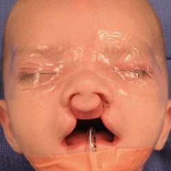 Cleft Lip Before & After Patient #1107