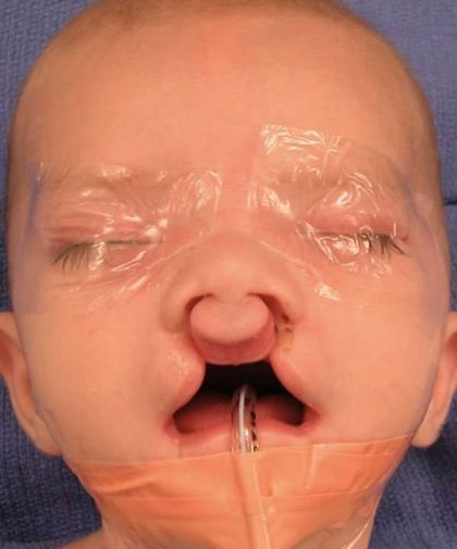 Cleft Lip Before & After Patient #1107
