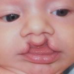 Cleft Lip Before & After Patient #1110