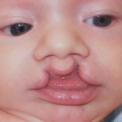 Cleft Lip Before & After Patient #1110