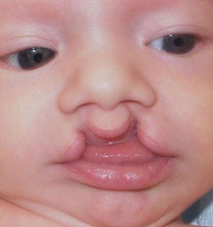 Cleft Lip Before & After Patient #1110