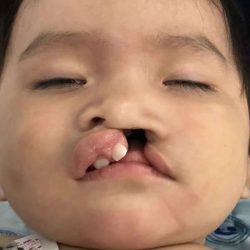 Cleft Lip Before & After Patient #1116