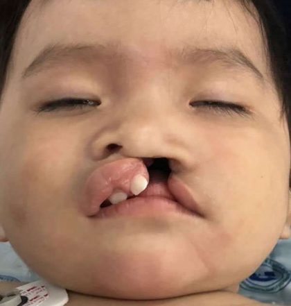 Cleft Lip Before & After Patient #1116