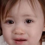 Cleft Lip Before & After Patient #1119