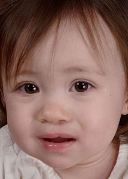 Cleft Lip Before & After Patient #1119