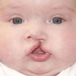 Cleft Lip Before & After Patient #1122