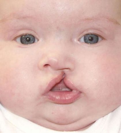 Cleft Lip Before & After Patient #1122