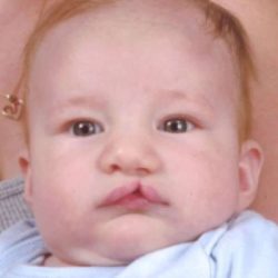 Cleft Lip Before & After Patient #1125