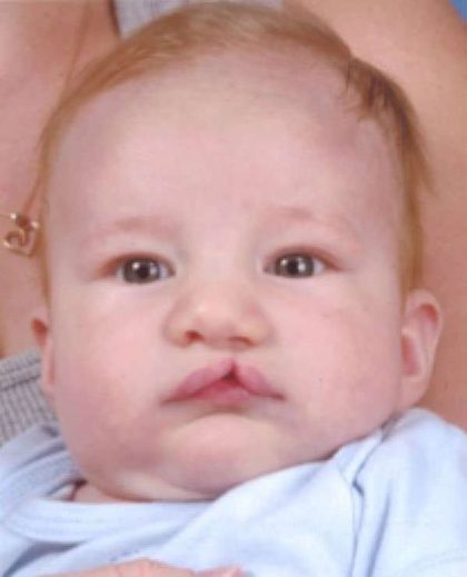 Cleft Lip Before & After Patient #1125