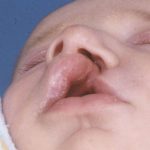 Cleft Lip Before & After Patient #1128