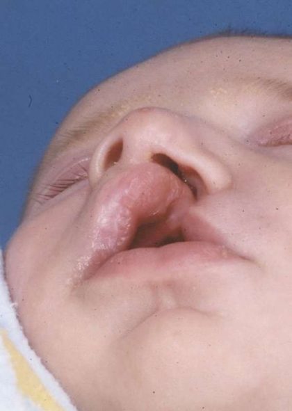 Cleft Lip Before & After Patient #1128