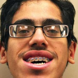 Jaw Surgery Before & After Patient #1137