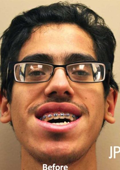 Jaw Surgery Before & After Patient #1137
