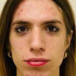 Facial Feminization Before & After Patient #900