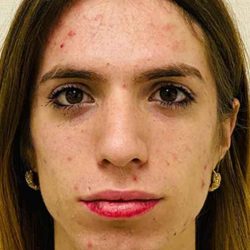 Facial Feminization Before & After Patient #900