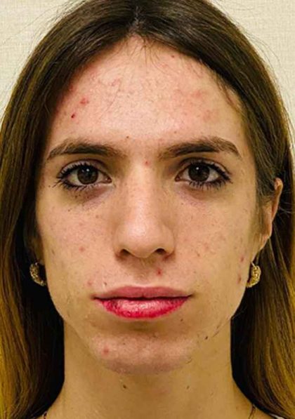 Facial Feminization Before & After Patient #900