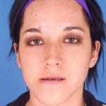 Jaw Surgery Before & After Patient #1161