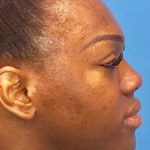 Facial Feminization Before & After Patient #918
