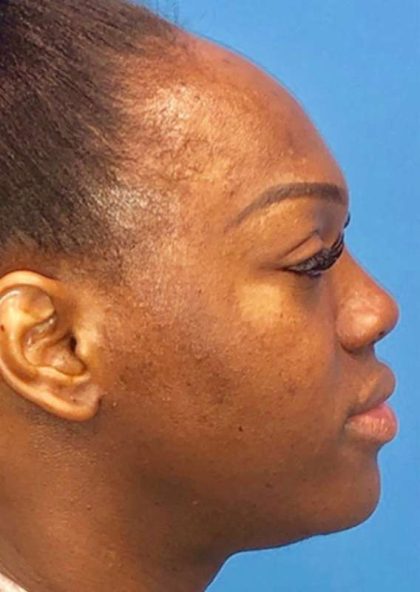 Facial Feminization Before & After Patient #918