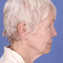 Facelift Before & After Patient #993