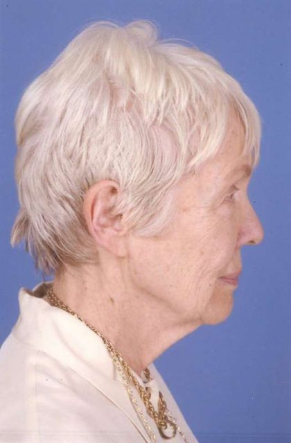 Facelift Before & After Patient #993