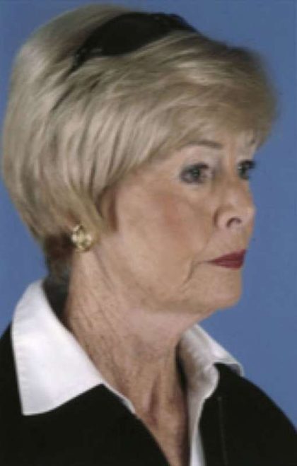 Facelift Before & After Patient #987