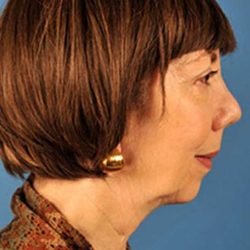 Facelift Before & After Patient #975