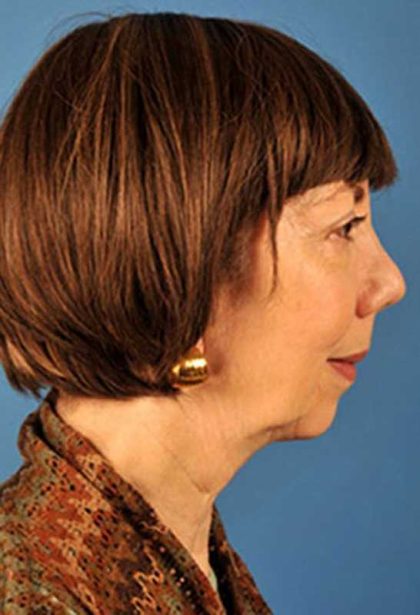 Facelift Before & After Patient #975