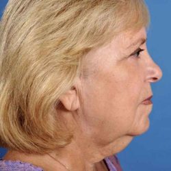 Facelift Before & After Patient #969