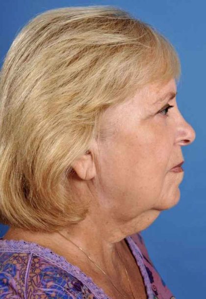 Facelift Before & After Patient #969