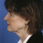 Facelift Before & After Patient #963