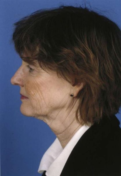 Facelift Before & After Patient #963