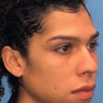 Facial Feminization Before & After Patient #924