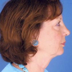 Facelift Before & After Patient #957