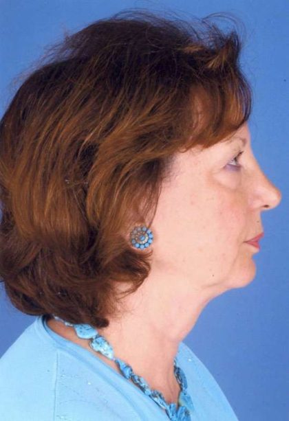 Facelift Before & After Patient #957