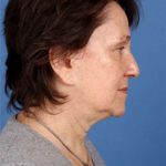 Facelift Before & After Patient #951