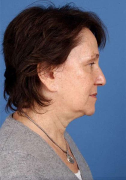 Facelift Before & After Patient #951