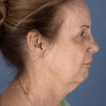 Facelift Before & After Patient #945