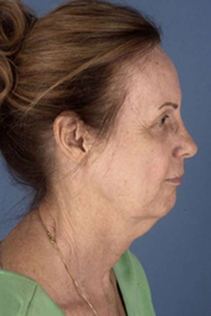 Facelift Before & After Patient #945
