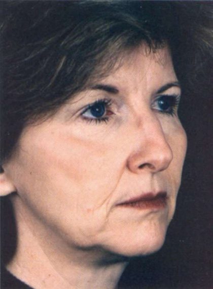 Facelift Before & After Patient #939