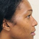 Facial Feminization Before & After Patient #912