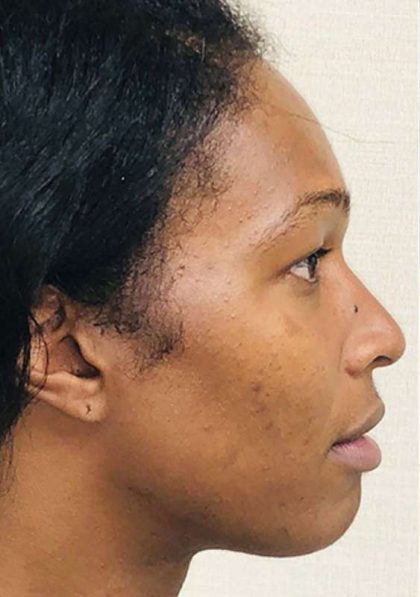 Facial Feminization Before & After Patient #912