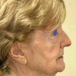 Facelift Before & After Patient #930