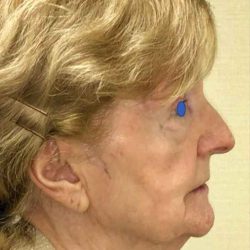 Facelift Before & After Patient #930