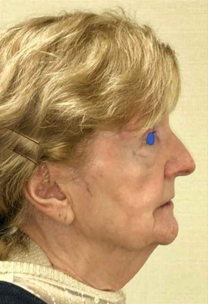 Facelift Before & After Patient #930